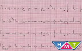 EKG.jpg ЭКГ, ЭлектроКардиоГрамма