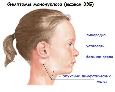 simptomy_mononukleoza_u_detey.jpeg